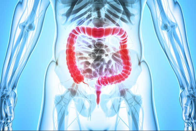illustration of large intestine, Crohn's disease and ulcers