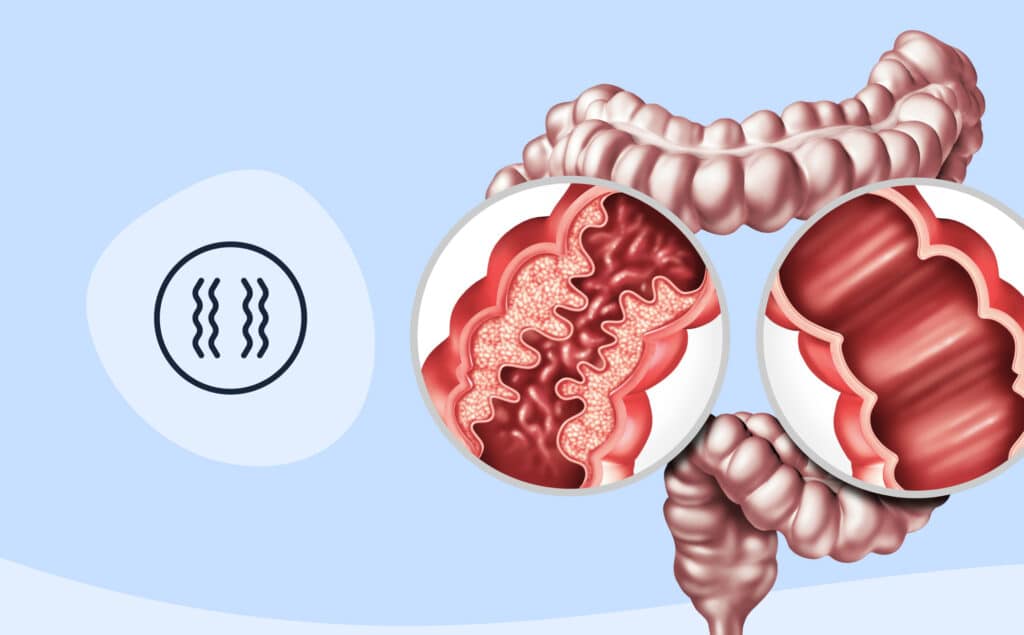 medical illustration of IBD-affected intestines