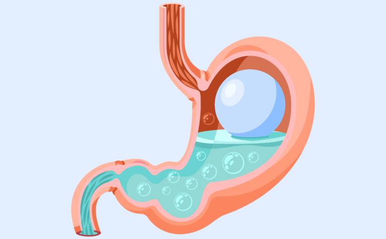 Is acid reflux dangerous? - Oshi Health