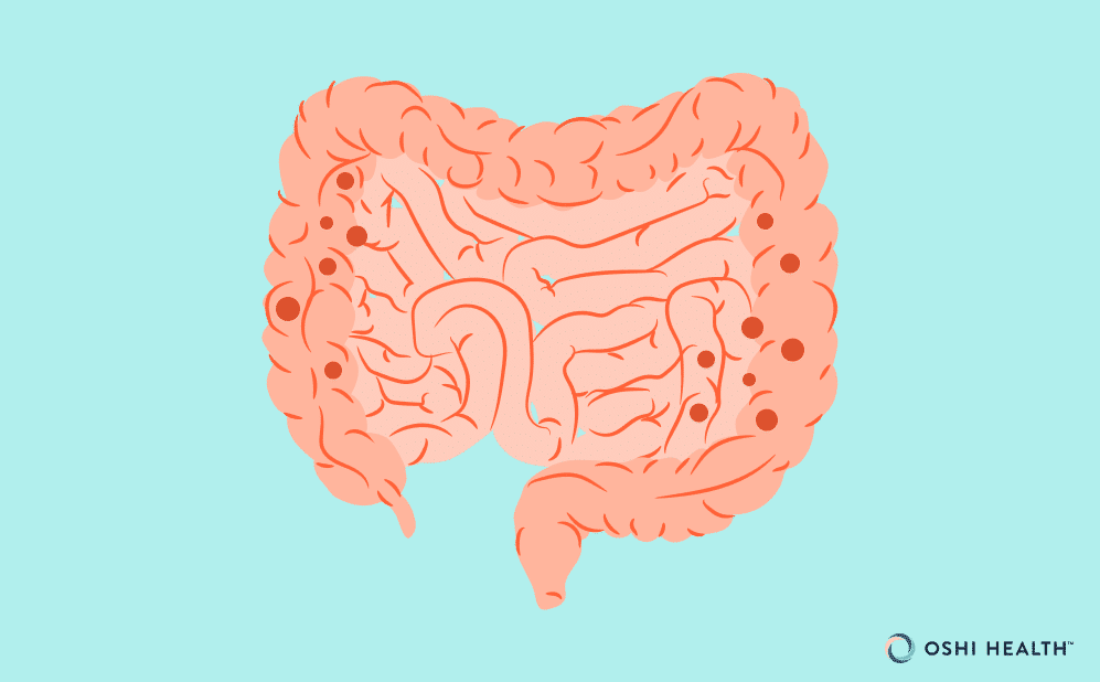 The best new treatments for diverticulitis