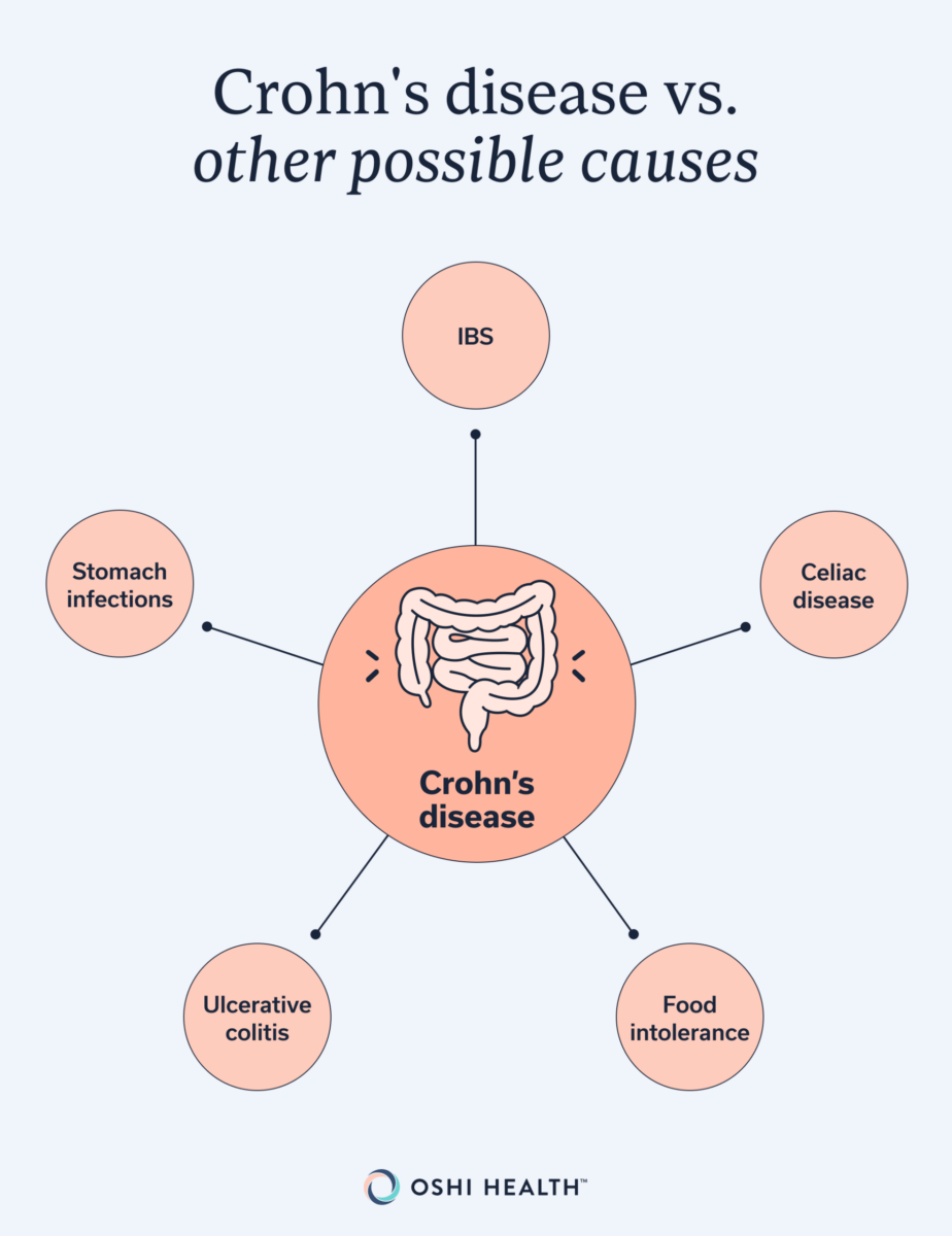 Diagram comparing Crohn’s disease with other possible causes of similar symptoms, including IBS, stomach infections, celiac disease, ulcerative colitis, and food intolerance.