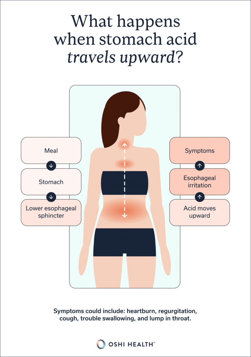 Illustration showing stomach acid moving upward into the esophagus.